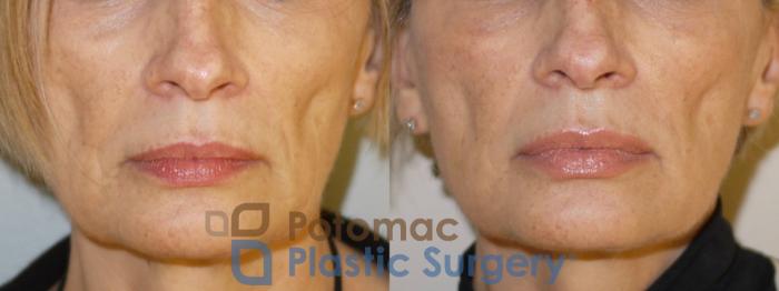 Before & After Dermal Fillers Case 75 Front View in Washington DC & Arlington , DC