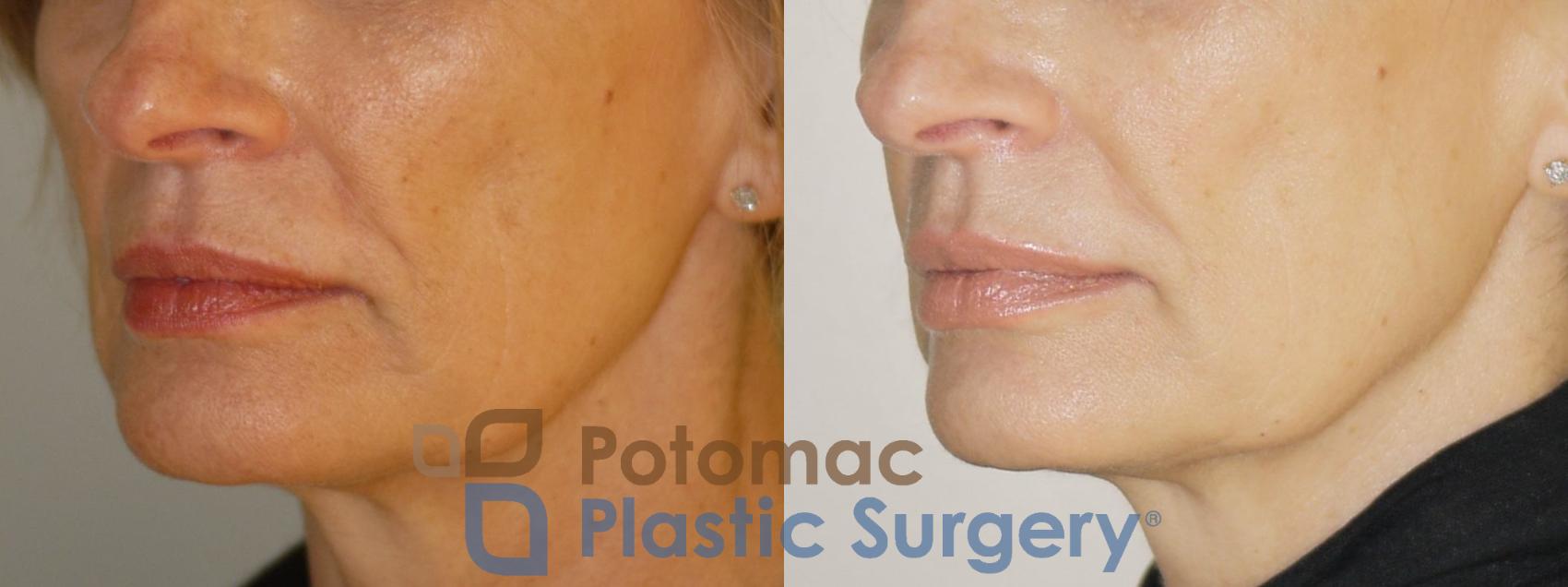 Before & After Fat Transfer Case 75 Left Oblique View in Washington DC & Arlington , DC