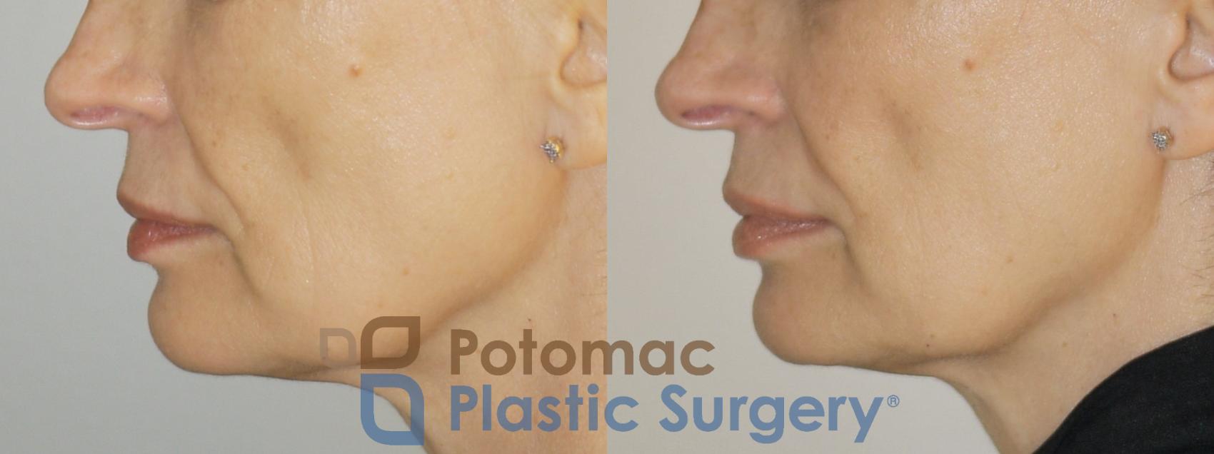 Before & After Fat Transfer Case 75 Left Side View in Washington DC & Arlington , DC