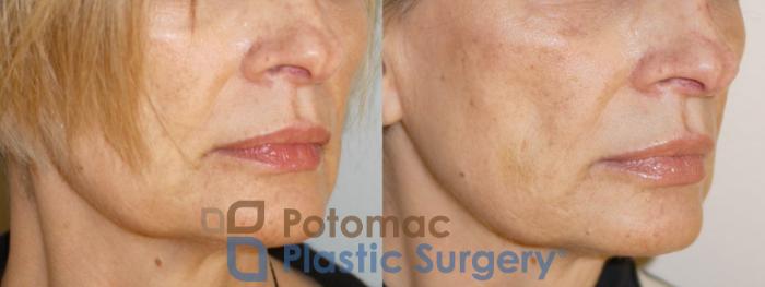 Before & After Dermal Fillers Case 75 Right Oblique View in Washington DC & Arlington , DC