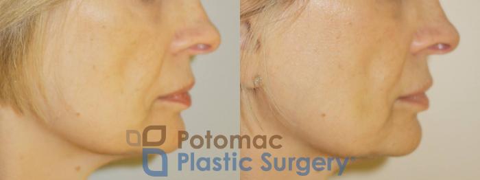 Before & After Dermal Fillers Case 75 Right Side View in Washington DC & Arlington , DC