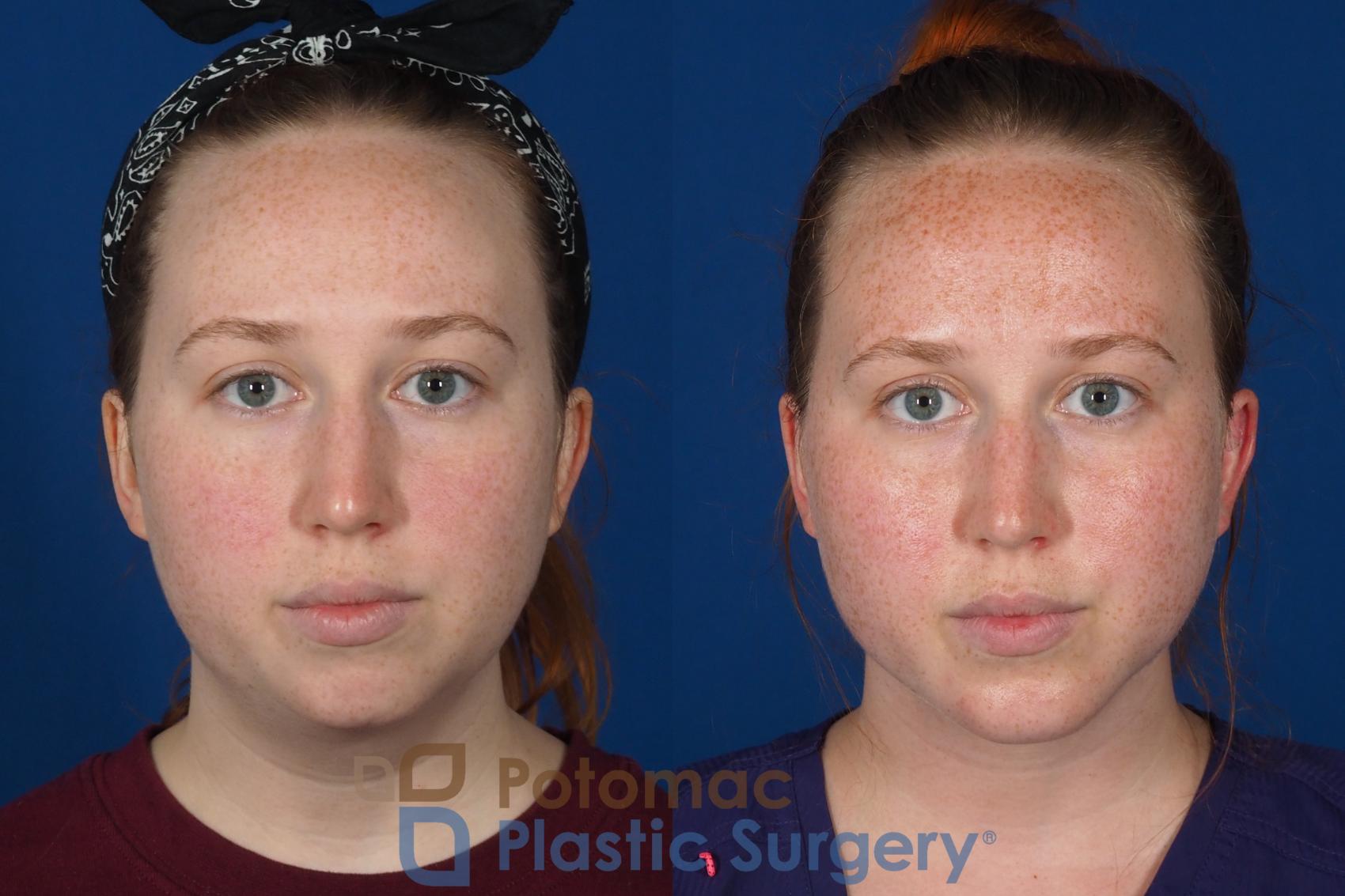 Before & After Liposuction Case 299 Front View in Washington, DC
