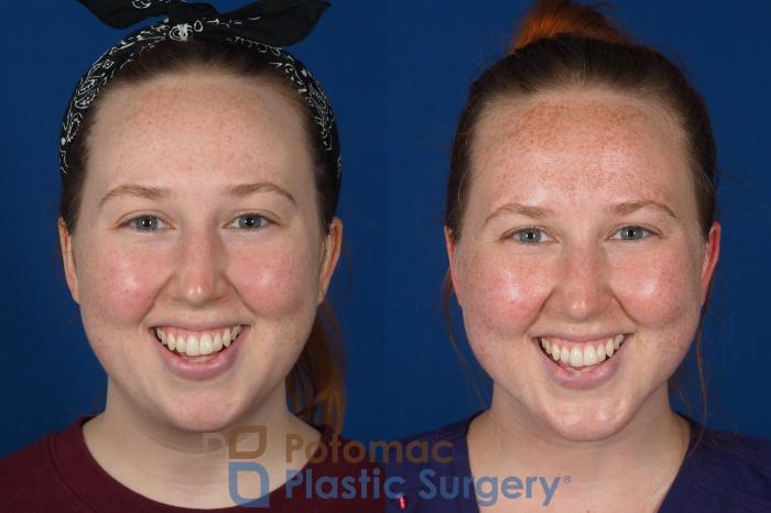 Before & After Chin Augmentation Case 299 Front - Smiling View in Washington DC & Arlington , DC