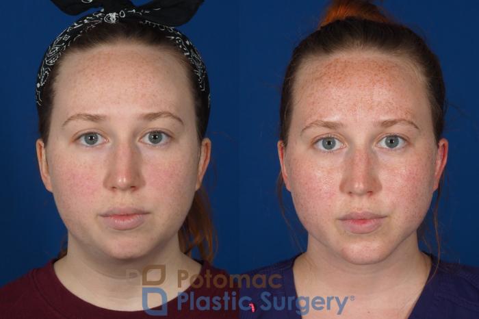 Before & After Chin Augmentation Case 299 Front View in Washington DC & Arlington , DC
