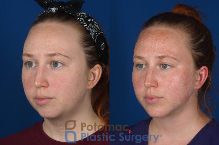 Before & After Chin Augmentation Case 299 Left Oblique View in Washington DC & Arlington , DC