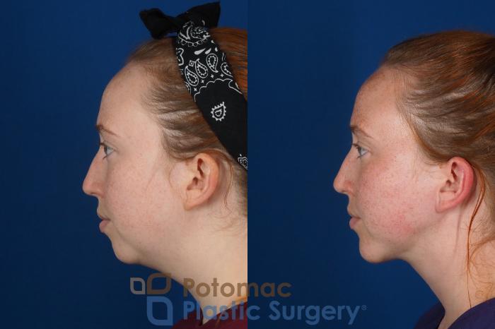 Before & After Chin Augmentation Case 299 Left Side View in Washington DC & Arlington , DC