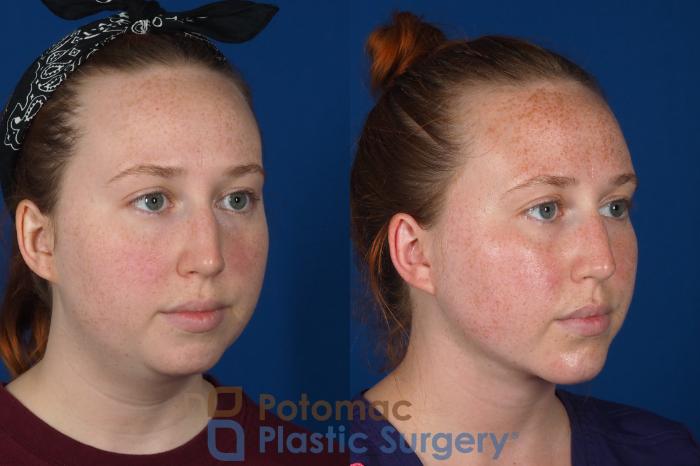 Before & After Chin Augmentation Case 299 Right Oblique View in Washington DC & Arlington , DC