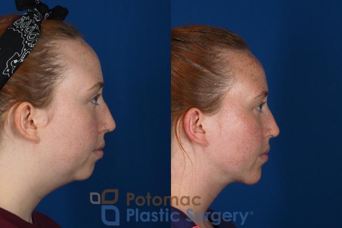 Before & After Facial Sculpting Case 299 Right Side View in Washington DC & Arlington , DC