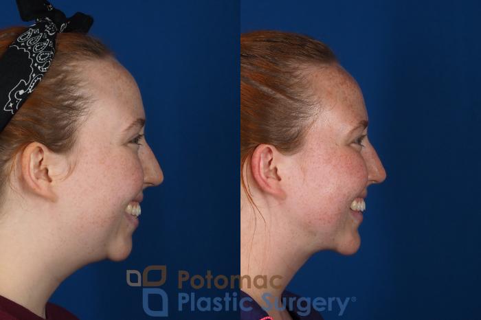 Before & After Chin Augmentation Case 299 Right - Smiling View in Washington DC & Arlington , DC