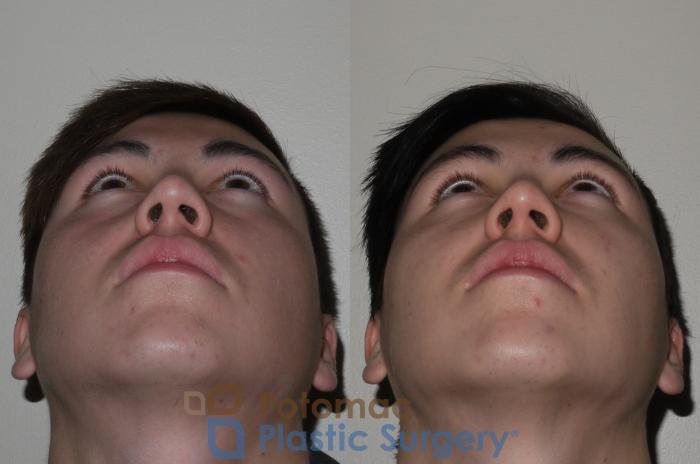 Before & After Liquid Facelift Case 114 Bottom View in Washington DC & Arlington , DC