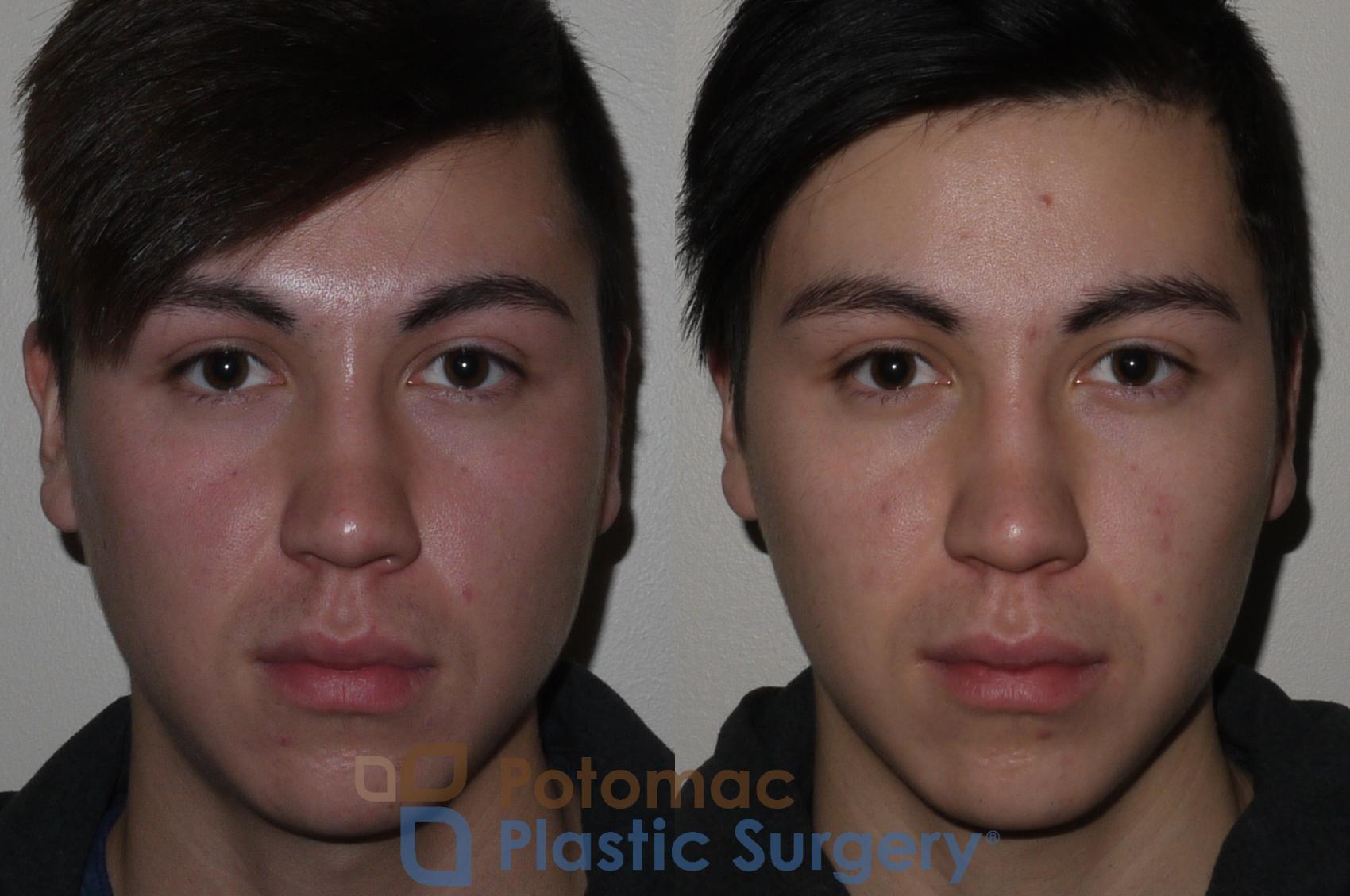 Before & After Liquid Facelift Case 114 Front View in Washington DC & Arlington , DC