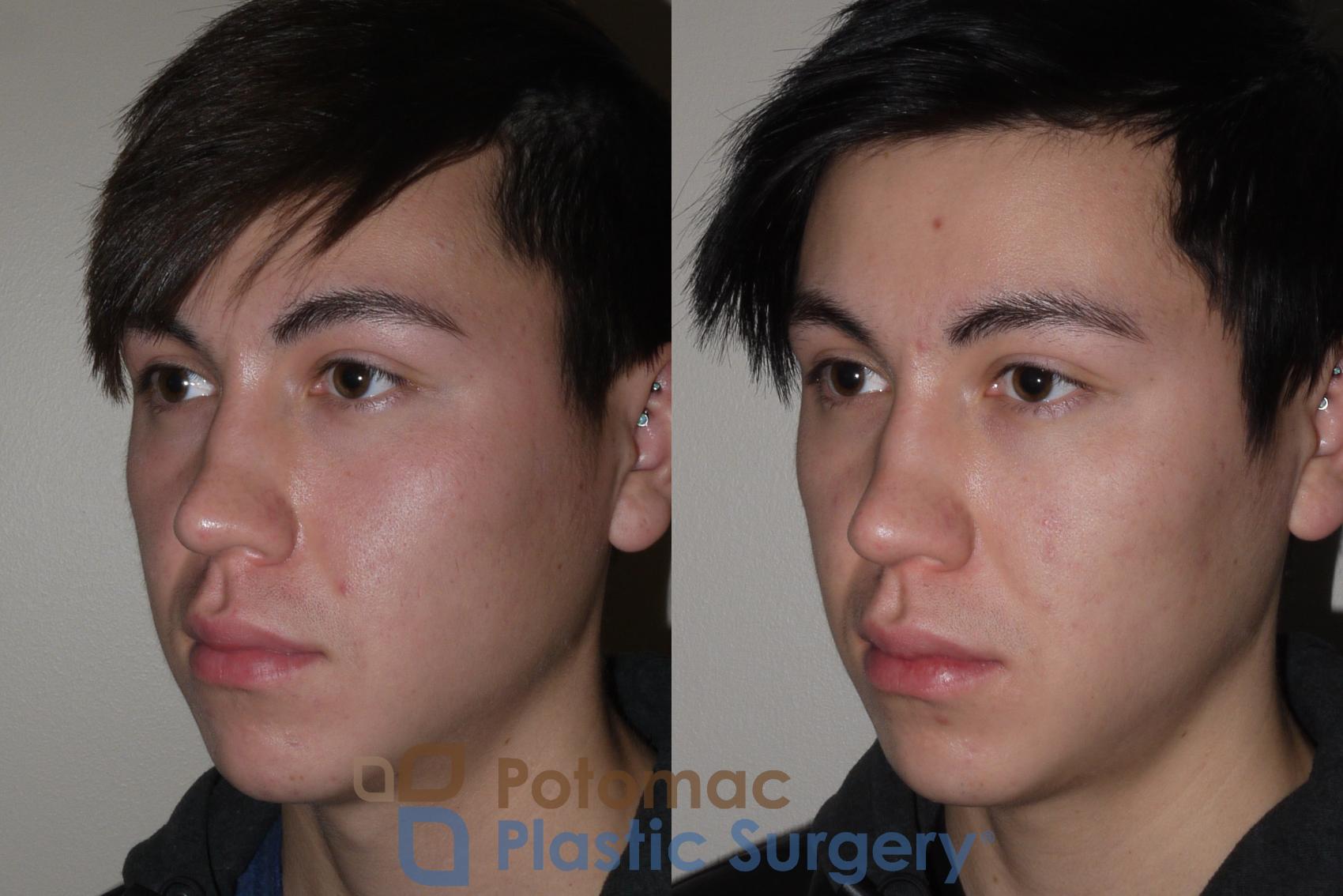 Before & After Liquid Facelift Case 114 Left Oblique View in Washington DC & Arlington , DC