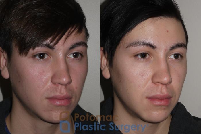 Before & After Dermal Fillers Case 114 Right Oblique View in Washington DC & Arlington , DC