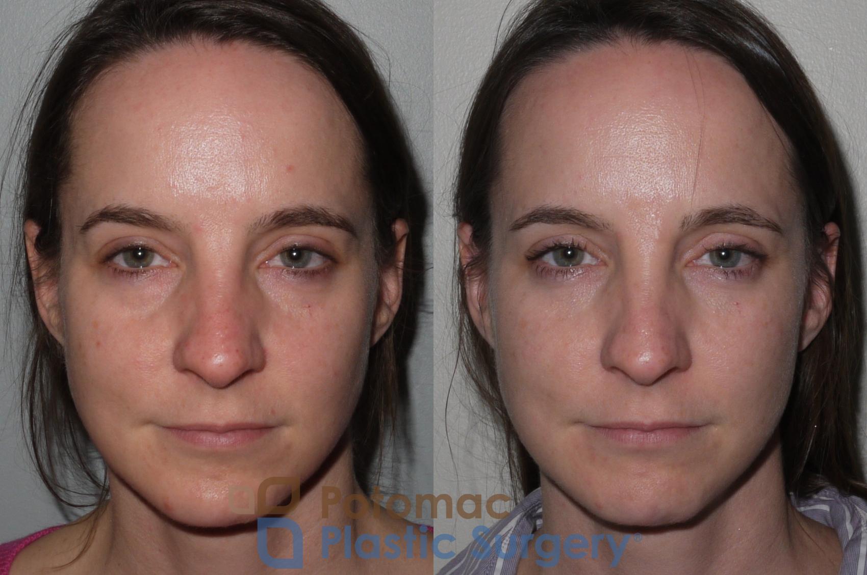 Before & After Liquid Facelift Case 118 Front View in Washington DC & Arlington , DC