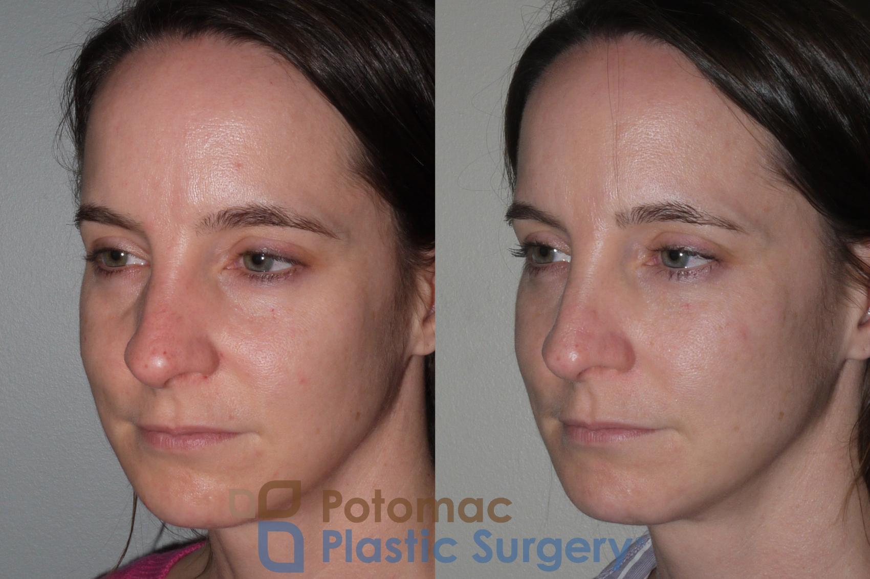 Before & After Liquid Facelift Case 118 Left Oblique View in Washington DC & Arlington , DC