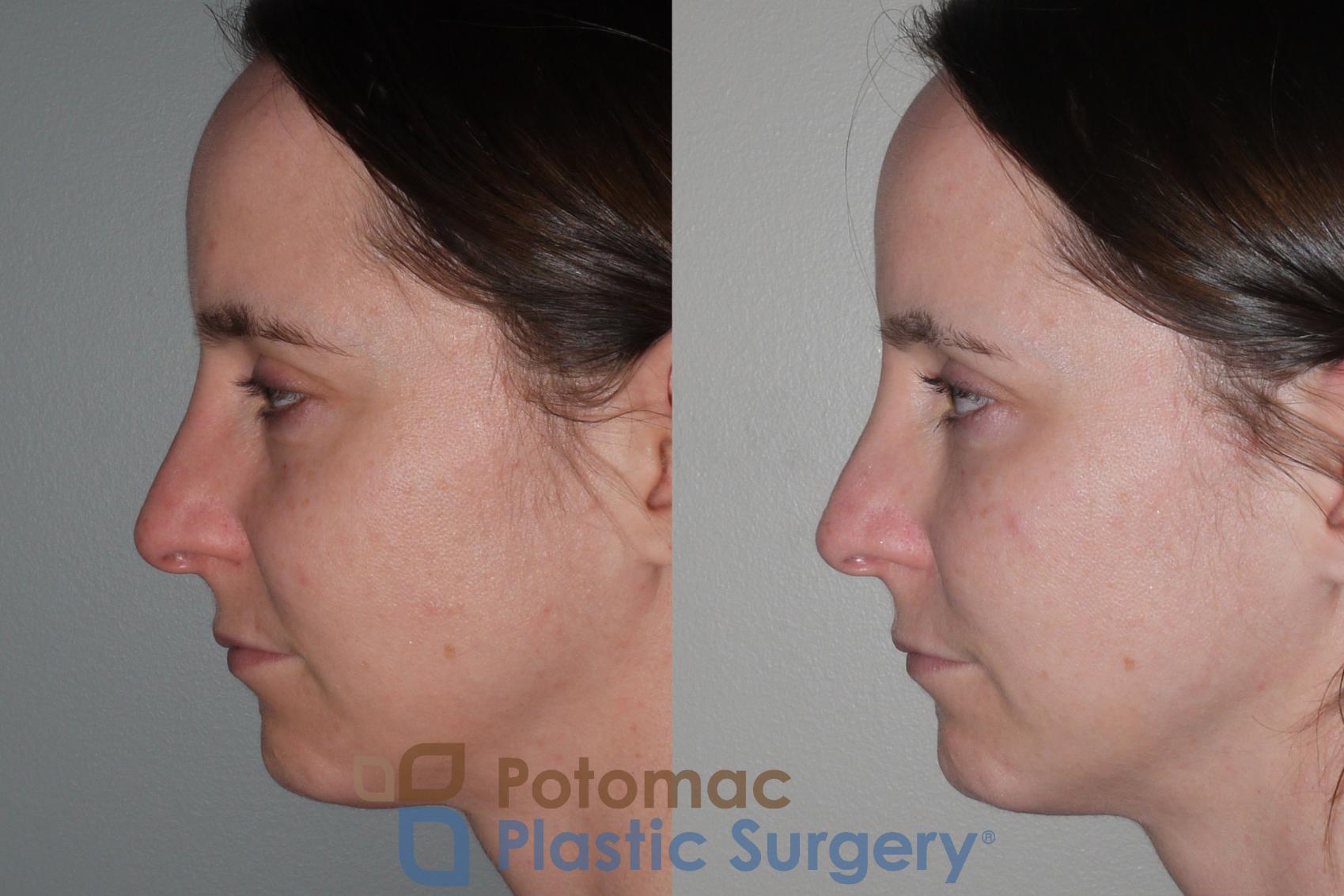 Before & After Liquid Facelift Case 118 Left Side View in Washington DC & Arlington , DC