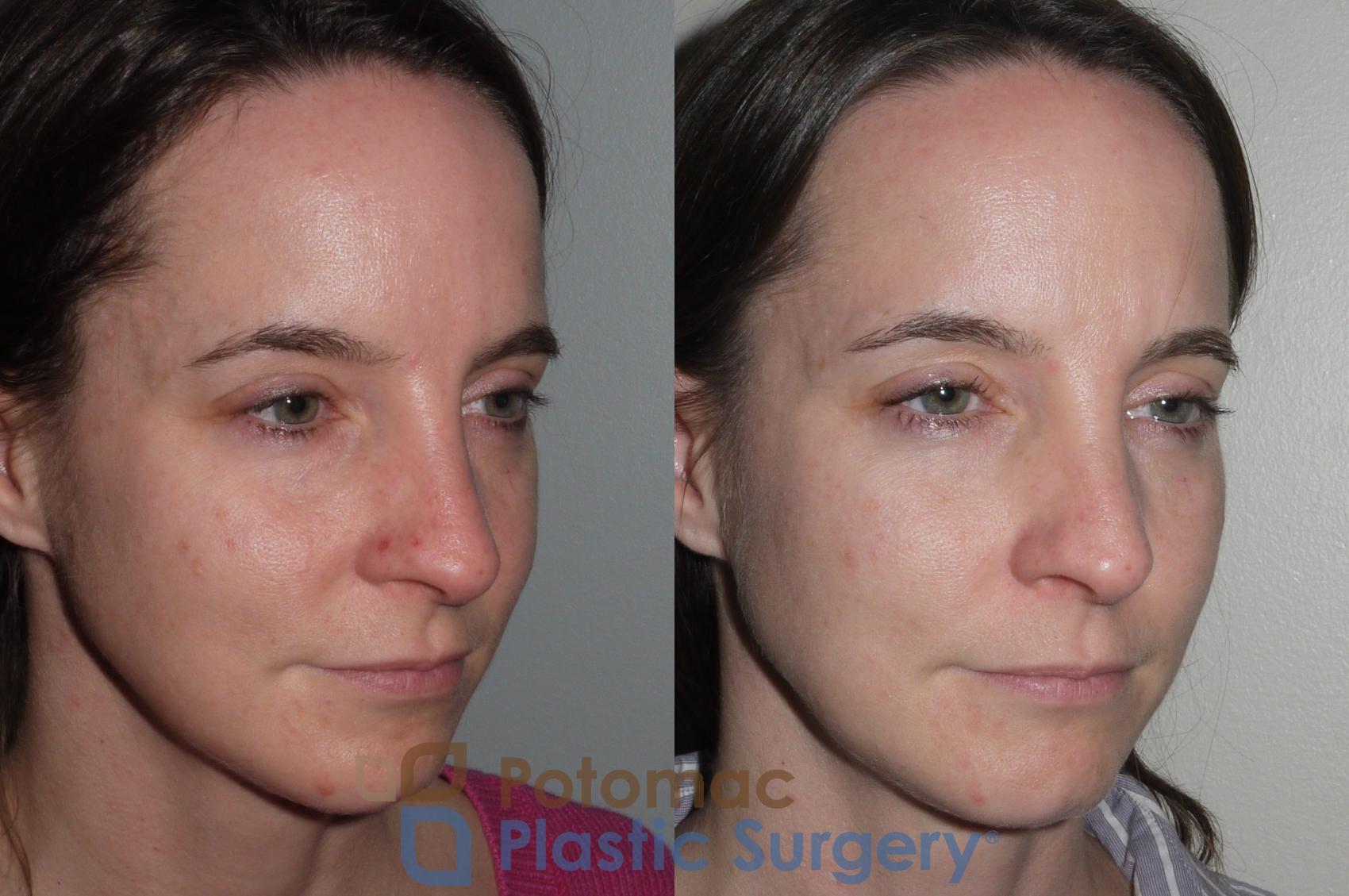Before & After Liquid Facelift Case 118 Right Oblique View in Washington DC & Arlington , DC