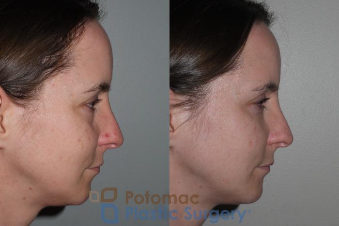 Before & After Liquid Facelift Case 118 Right Side View in Washington DC & Arlington , DC