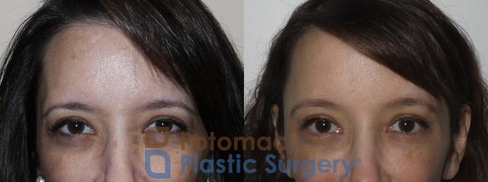 Before & After Liquid Facelift Case 136 Front View in Washington DC & Arlington , DC