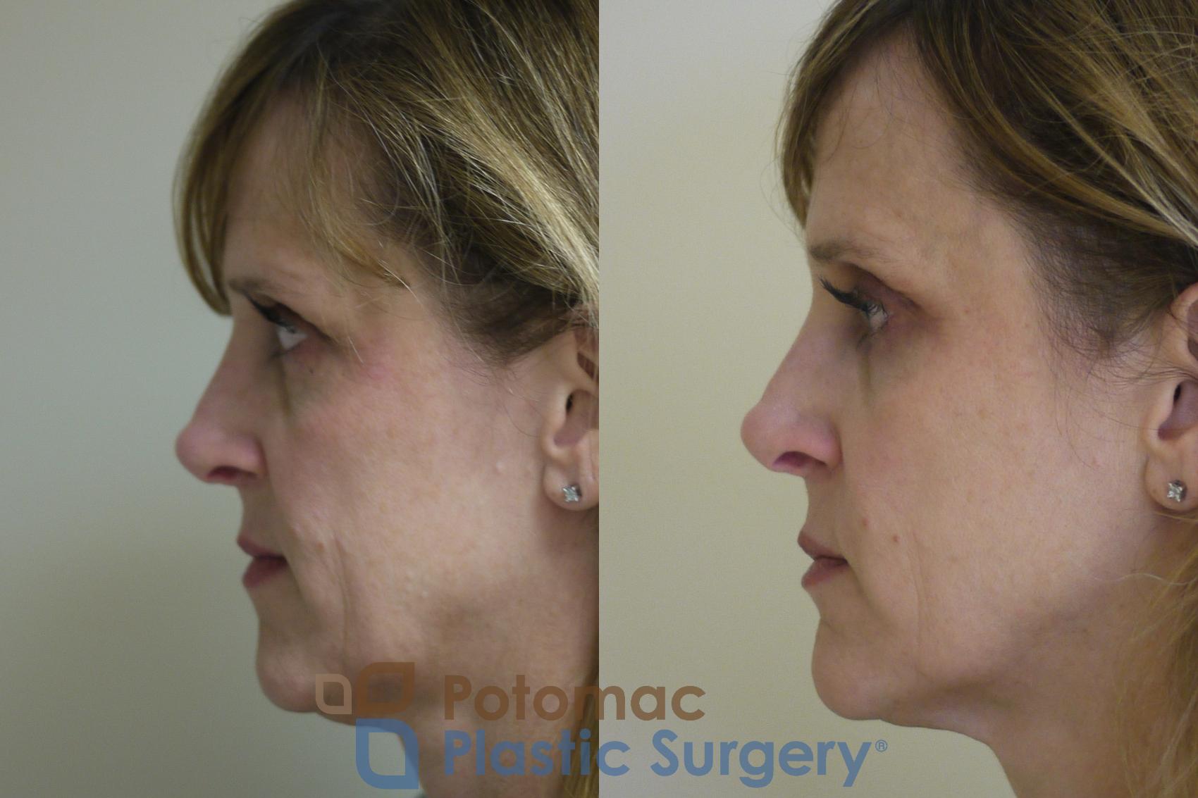 Before & After Liquid Facelift Case 138 Left Side View in Washington, DC