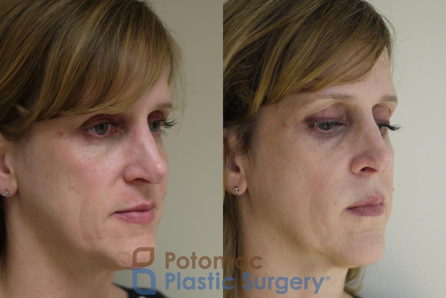 Before & After Liquid Facelift Case 138 Right Oblique View in Washington, DC