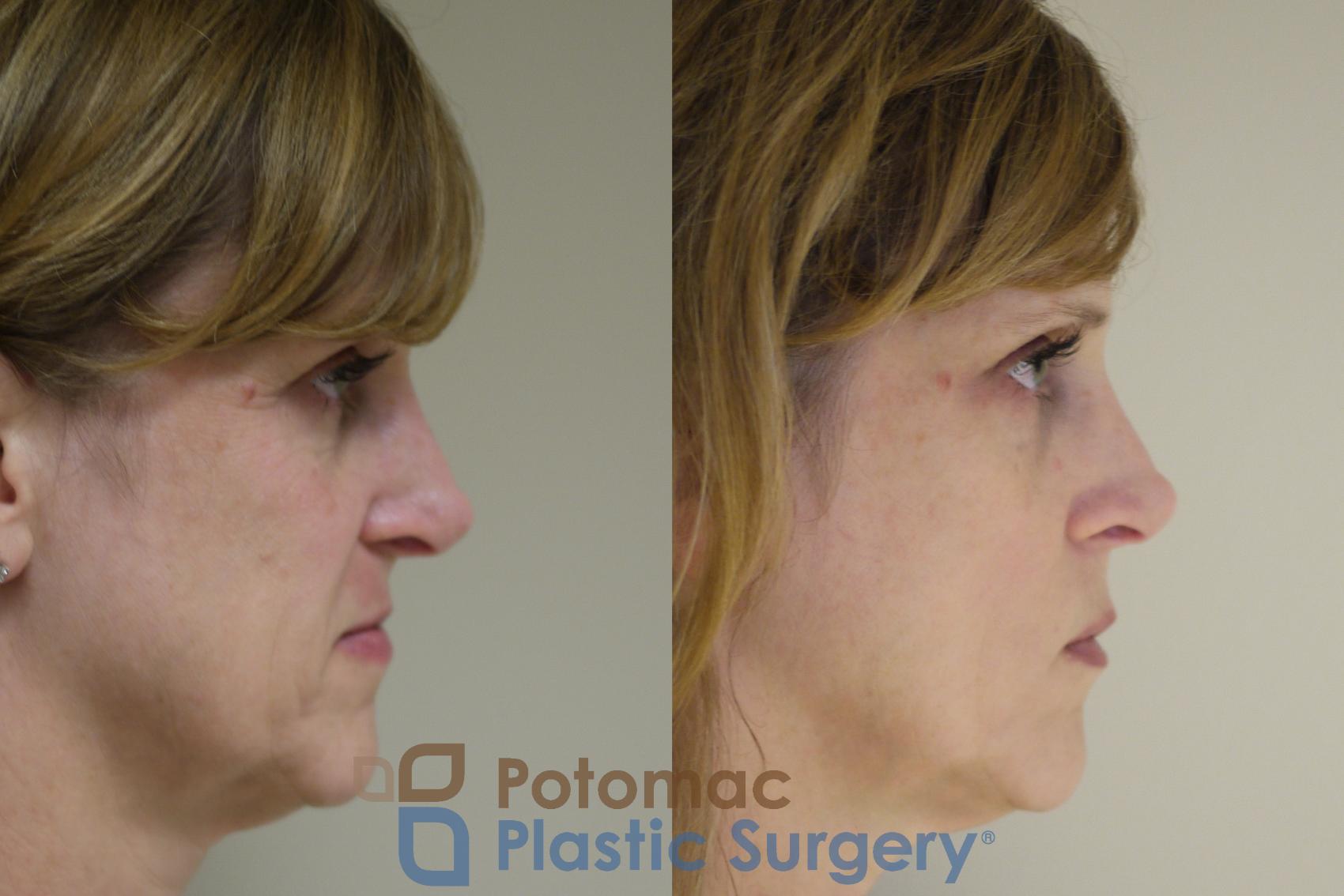 Before & After Liquid Facelift Case 138 Right Side View in Washington, DC