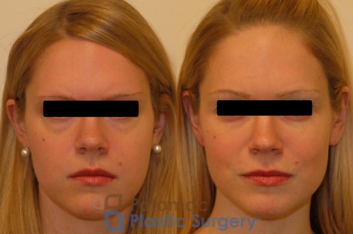 Before & After Liquid Facelift Case 141 Front View in Washington DC & Arlington , DC