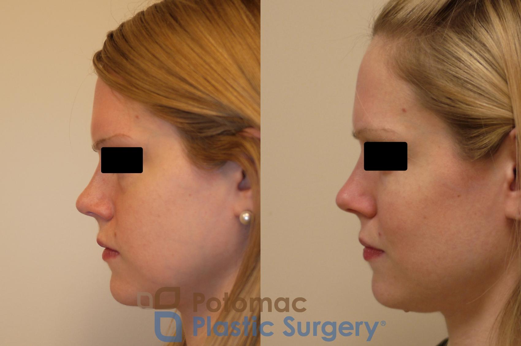 Before & After Liquid Facelift Case 141 Left Side View in Washington, DC