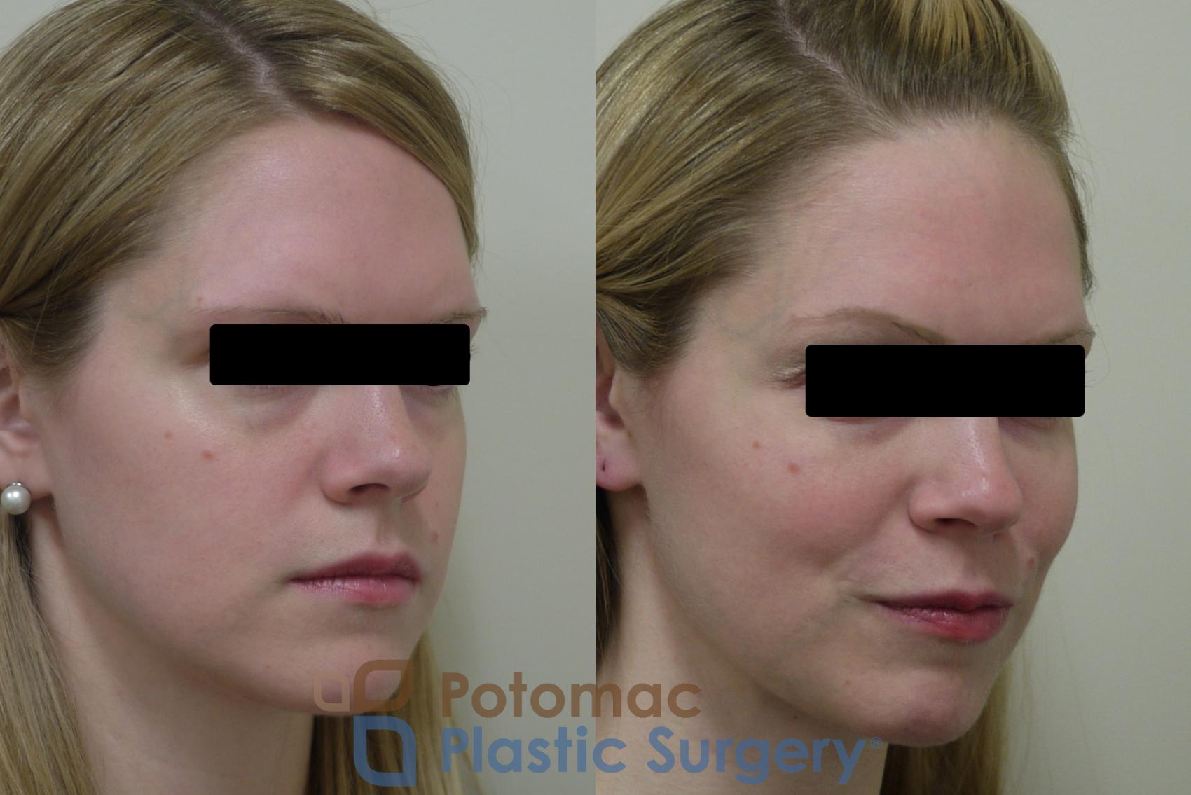 Before & After Liquid Facelift Case 141 Right Oblique View in Washington, DC