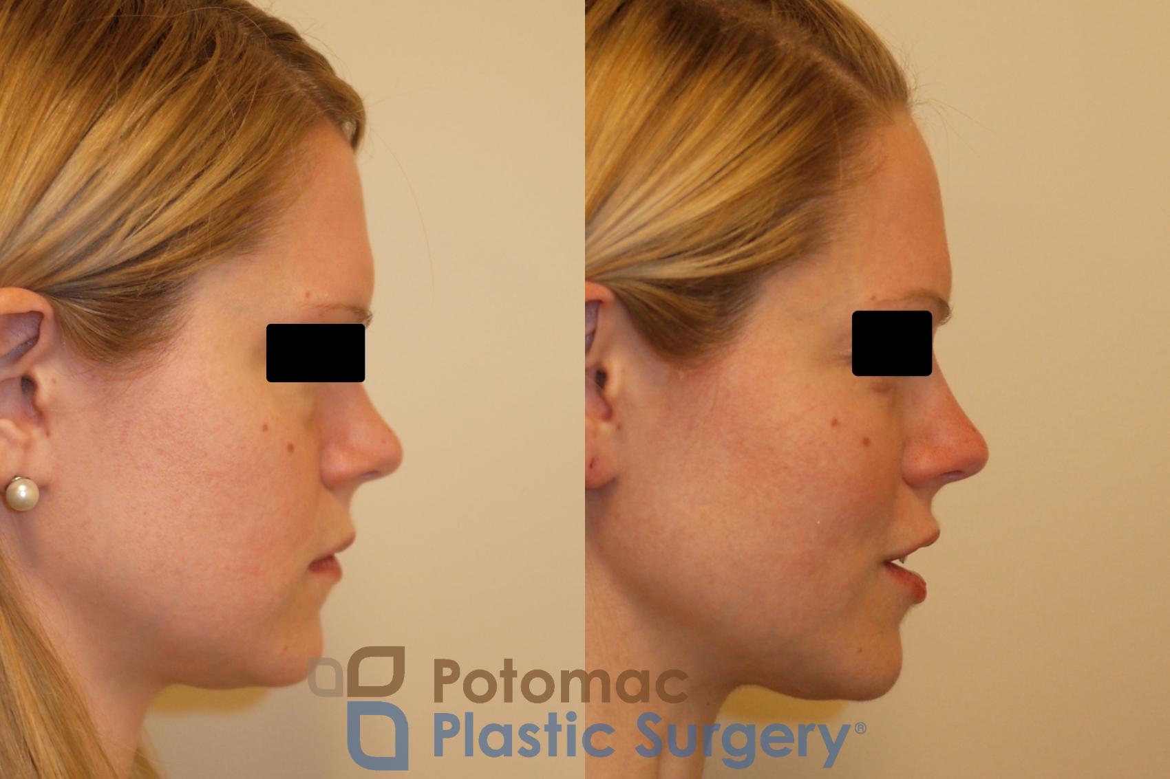 Before & After Liquid Facelift Case 141 Right Side View in Washington, DC