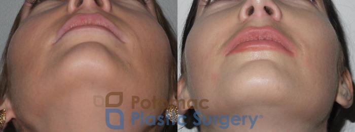 Before & After Botox Cosmetic Case 148 Below View in Washington DC & Arlington , DC