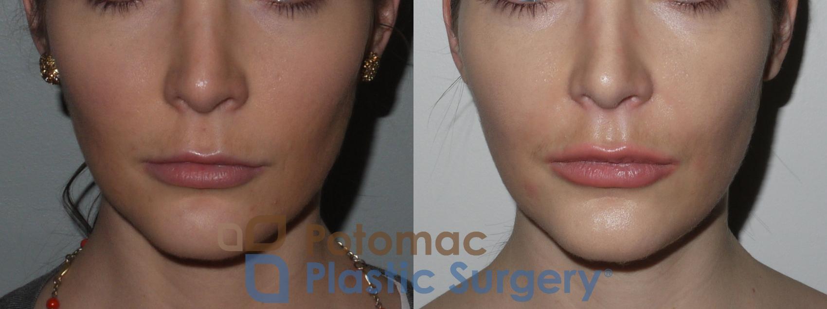 Before & After Botox Cosmetic Case 148 Front View in Washington DC & Arlington , DC
