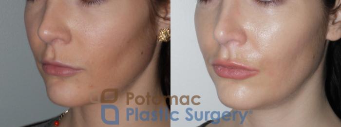 Before & After Botox Cosmetic Case 148 Left Oblique View in Washington DC & Arlington , DC
