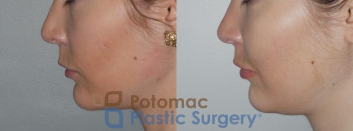 Before & After Botox Cosmetic Case 148 Left Side View in Washington DC & Arlington , DC