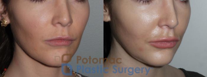 Before & After Botox Cosmetic Case 148 Right Oblique View in Washington DC & Arlington , DC