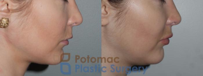 Before & After Botox Cosmetic Case 148 Right Side View in Washington DC & Arlington , DC