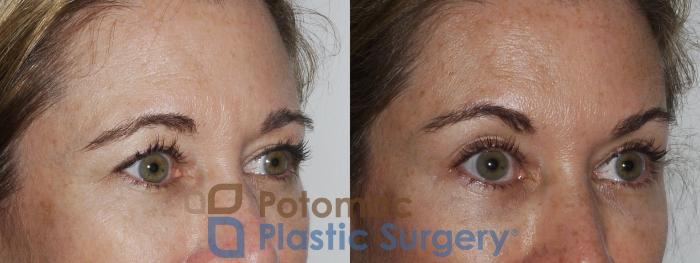 Before & After Brow Lift Case 182 Front Close-Up View #2 View in Washington, DC