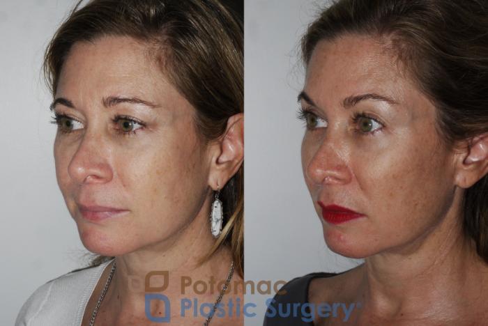 Before & After Brow Lift Case 182 Left Oblique View in Washington, DC