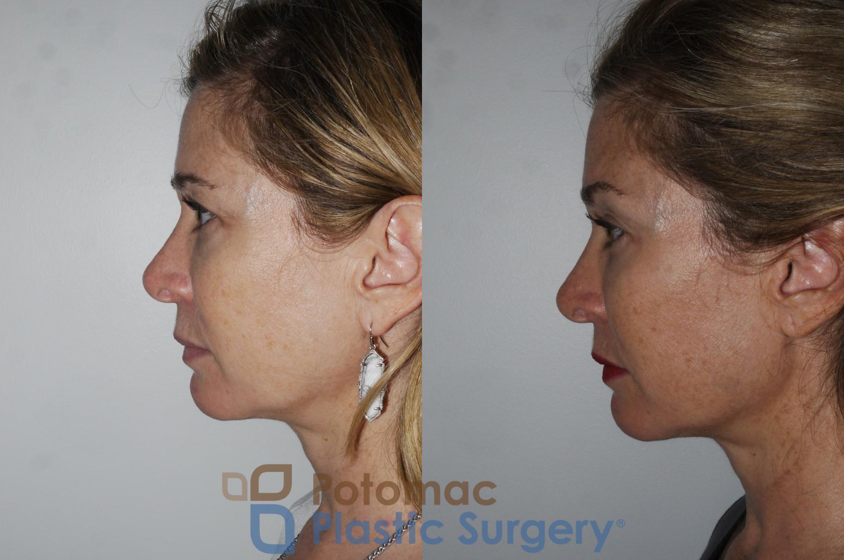 Before & After Liquid Facelift Case 182 Left Side View in Washington, DC
