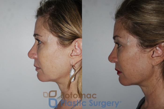 Before & After Brow Lift Case 182 Left Side View in Washington, DC