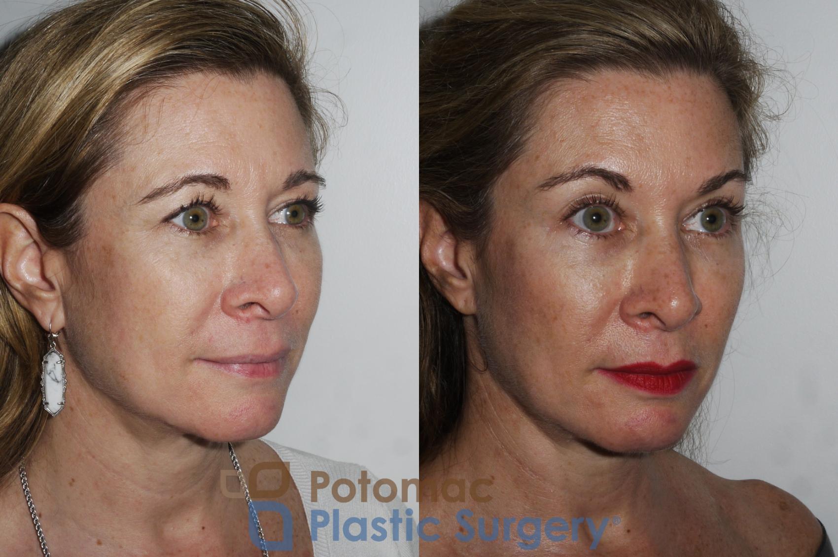 Before & After Liquid Facelift Case 182 Right Oblique View in Washington, DC