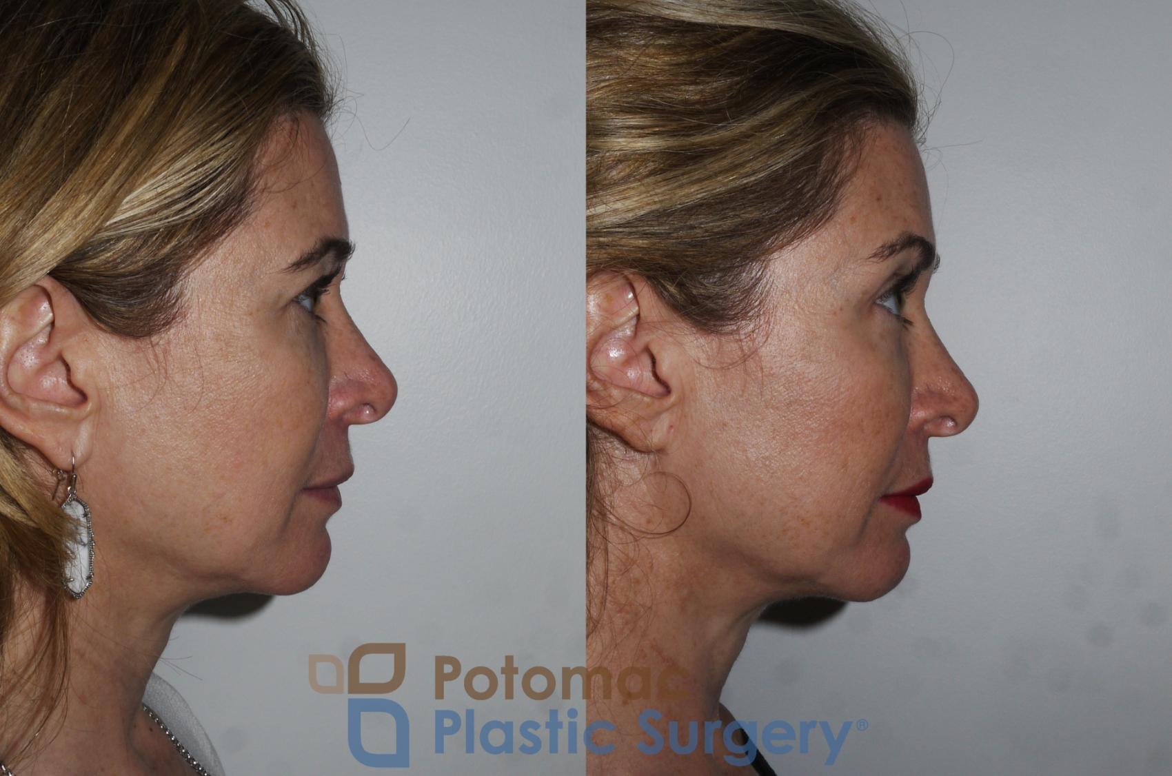 Before & After Liquid Facelift Case 182 Right Side View in Washington, DC