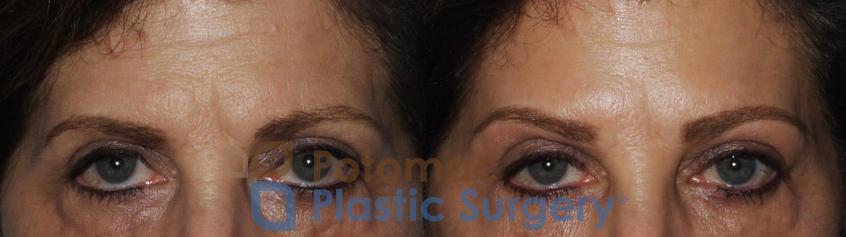 Before & After Botox Cosmetic Case 188 Front View #1 View in Washington, DC