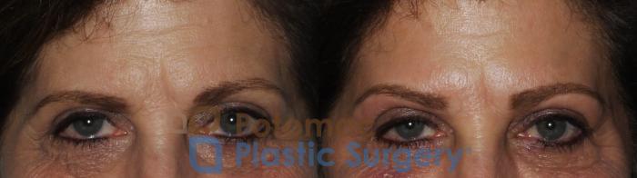 Before & After Botox Cosmetic Case 188 Front View #2 View in Washington DC & Arlington , DC