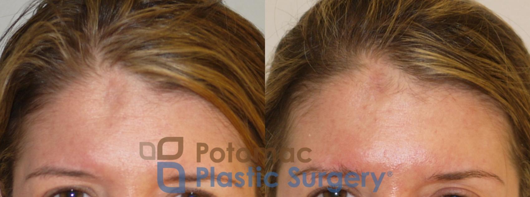 Before & After Facial Sculpting Case 191 Front View in Washington DC & Arlington , DC