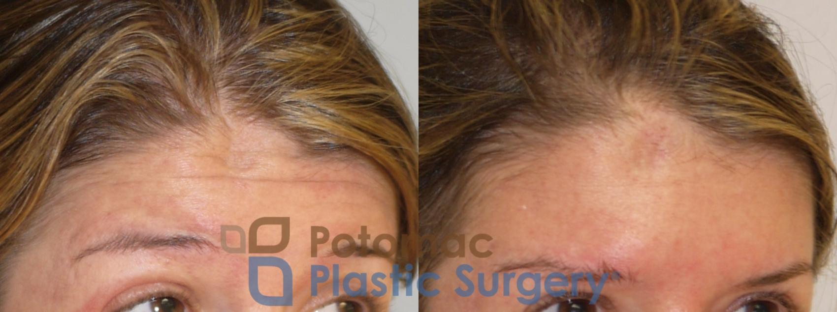 Before & After Liquid Facelift Case 191 Right Oblique View in Washington, DC