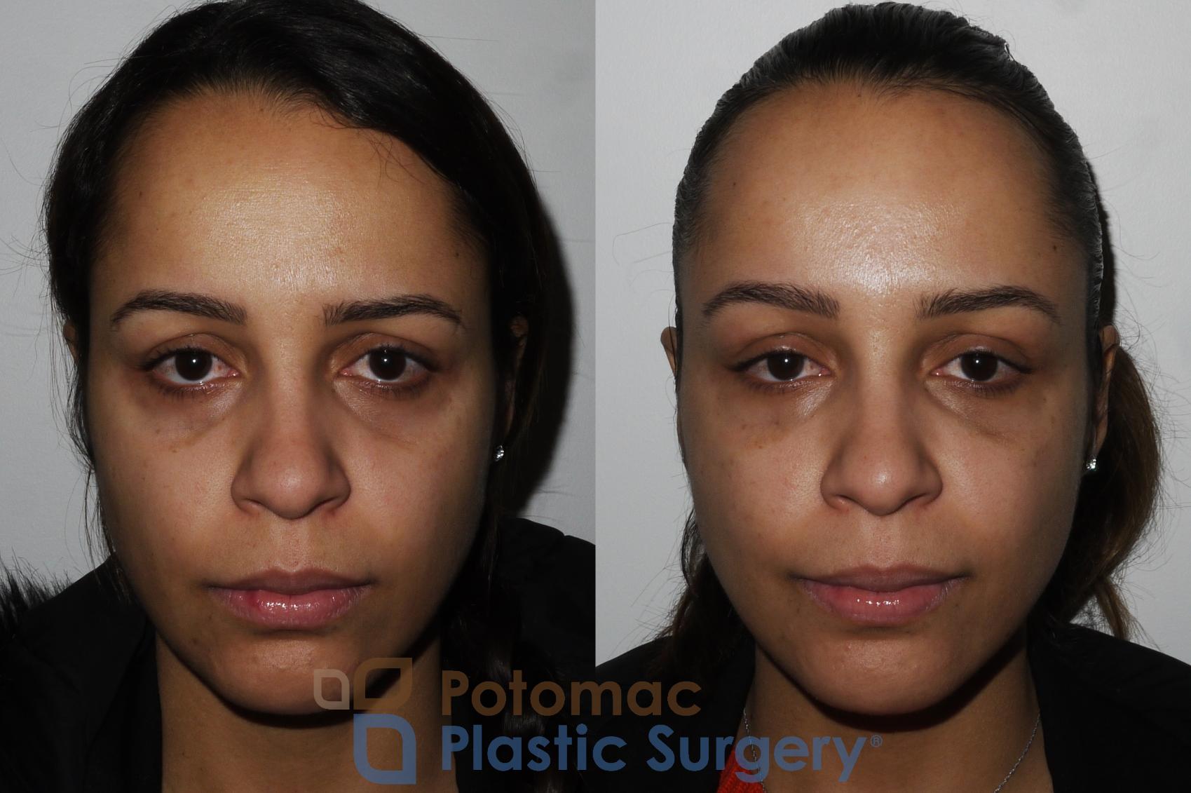 Before & After Liquid Facelift Case 194 Front View in Washington, DC