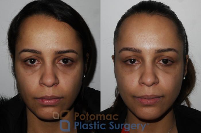 Before & After Liquid Facelift Case 194 Front View in Washington, DC