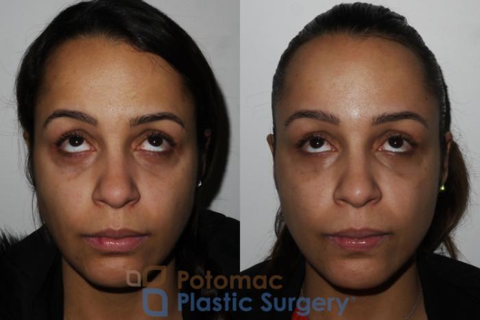 Before & After Skin Care Case 194 Front View #2 View in Washington, DC