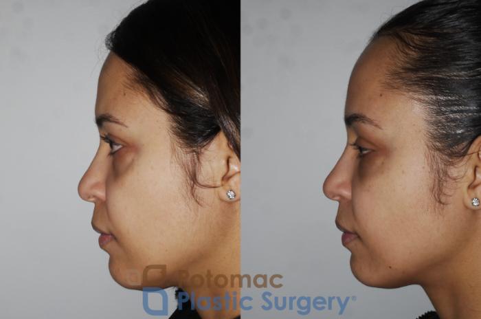 Before & After Liquid Facelift Case 194 Left Side View in Washington, DC